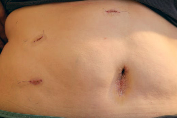 Gall Bladder Removal