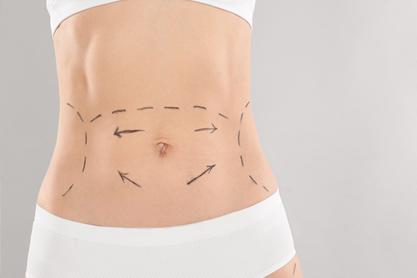 Abdominal Wall Reconstruction