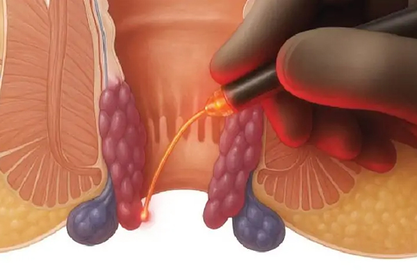 Laser Hemorrhoidectomy