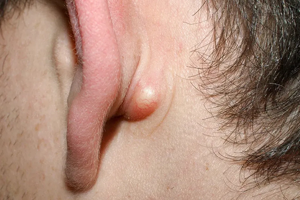 Cystic Swelling
