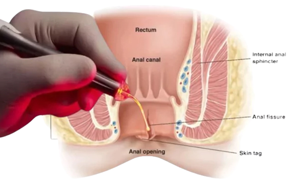 Fissurectomy