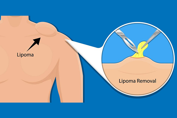 Lipoma Removal