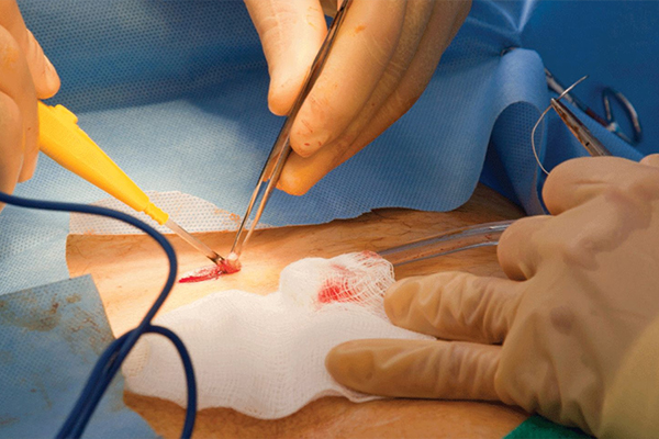 Abscess Surgery