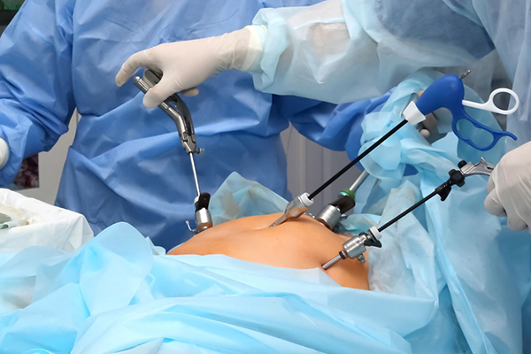 Appendicectomy